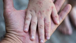 Detectan en Cuauht&eacute;moc casos del virus de coxsackie