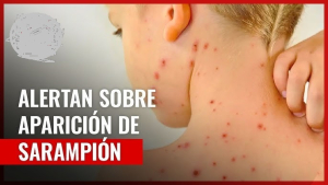Alertan sobre contagios del sarampi&oacute;n, Cuauht&eacute;moc con el mayor numero